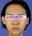 韩国BK整形外科面部不对称矫正对比案例