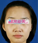 韩国BK整形外科隆鼻对比案例