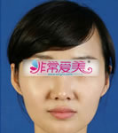 韩国BK整形外科隆鼻对比案例