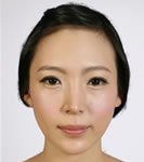 韩国BK整形医院-韩国BK医院双眼皮整形对比日记，美眼诞生竟如此简单！