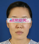韩国BK整形外科面部轮廓整形对比案例_术前