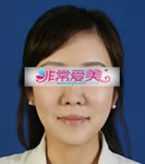 韩国BK整形外科面部轮廓整形对比案例_术后