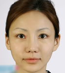 韩国BK整形医院-韩国BK整形外科开内眼角对比案例图