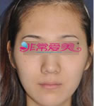 韩国4月31日整形外科面部填充手术案例_术前