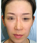 韩国REX整形外科-全脸脂肪移植填充