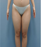 韩国REX整形外科-大腿内侧抽脂