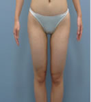韩国REX整形外科-大腿内侧抽脂