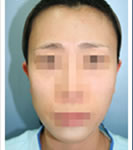 韩国REX整形外科-颧骨+方形下颌角矫正术