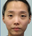 韩国珠儿丽-珠儿丽整形外科眼鼻整形对比照