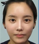 韩国珠儿丽-珠儿丽整形外科眼鼻整形对比照