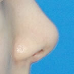 鼻部整形手术案例