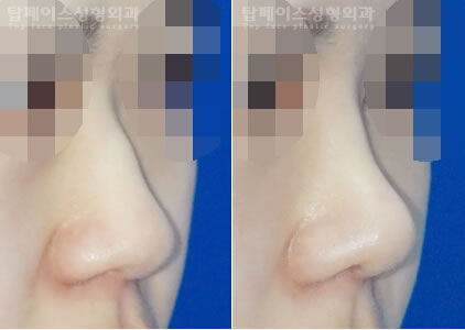 鼻部修复 鼻梁鼻头手术