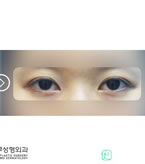 韩国那木整形-眼型矫正手术