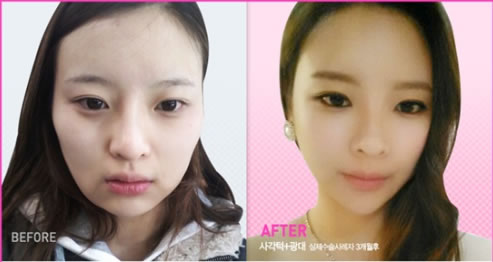 韩国TL整形医院求美者下颌角手术对比日记