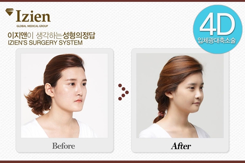 韩国一见整形外科面部整形前后对比照片