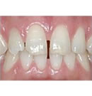 树脂牙齿美容术前术后对比案例_术前