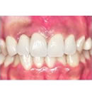 树脂牙齿美容术前术后对比案例_术后