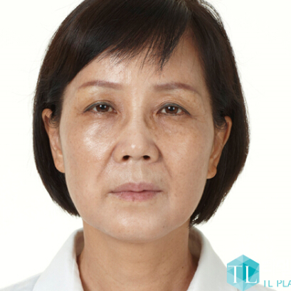 韩国TL整形医院-面部提升术对比案例