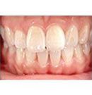 牙齿美白术前术后对比案例