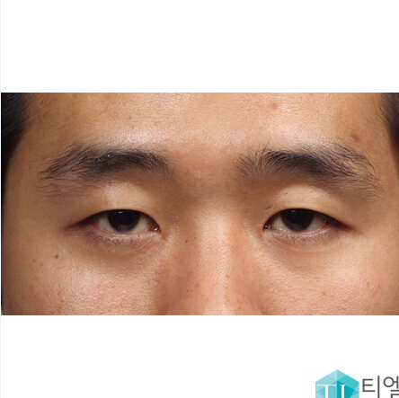 韩国TL整形医院-双眼皮整形对比案例