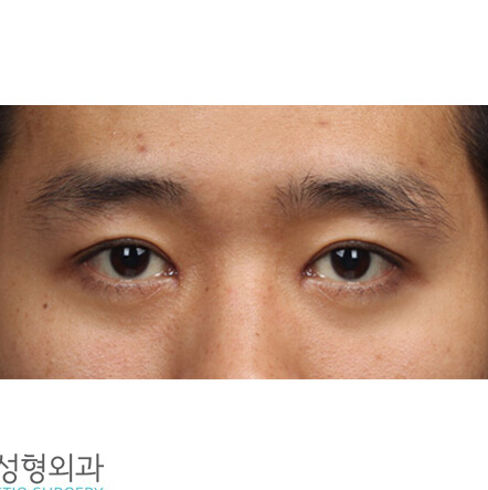 韩国TL整形医院-双眼皮整形对比案例