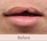 唇腭裂修复手术对比案例