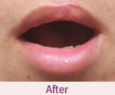 唇腭裂修复手术对比案例