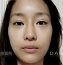韩国DA整形-颜面轮廓术前术后对比案例