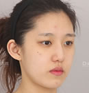 韩国DA整形-鼻头鼻翼整形术前术后对比案例