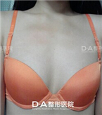 韩国DA整形-假体隆胸术前后对比案例