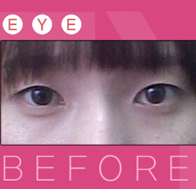 韩国DA整形-眼部整形对比案例