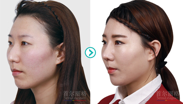 双眼皮+综合隆鼻整形对比案例