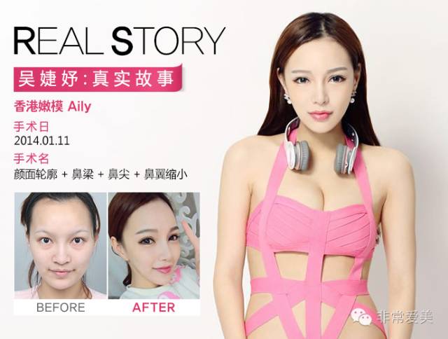 香港嫩模在DA整形外科做的面部轮廓手术，差别真的好大！