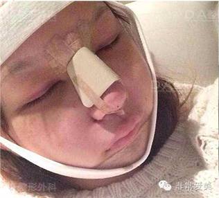 香港嫩模在DA整形外科做的面部轮廓手术，差别真的好大！