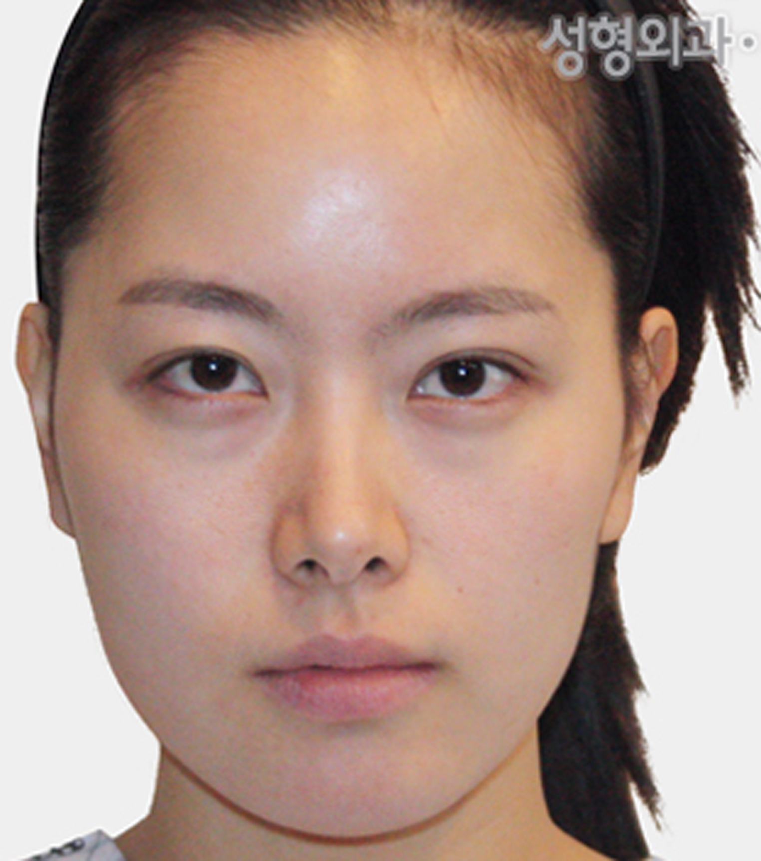 韩国FACE-LINE整形-V-line手术对比图