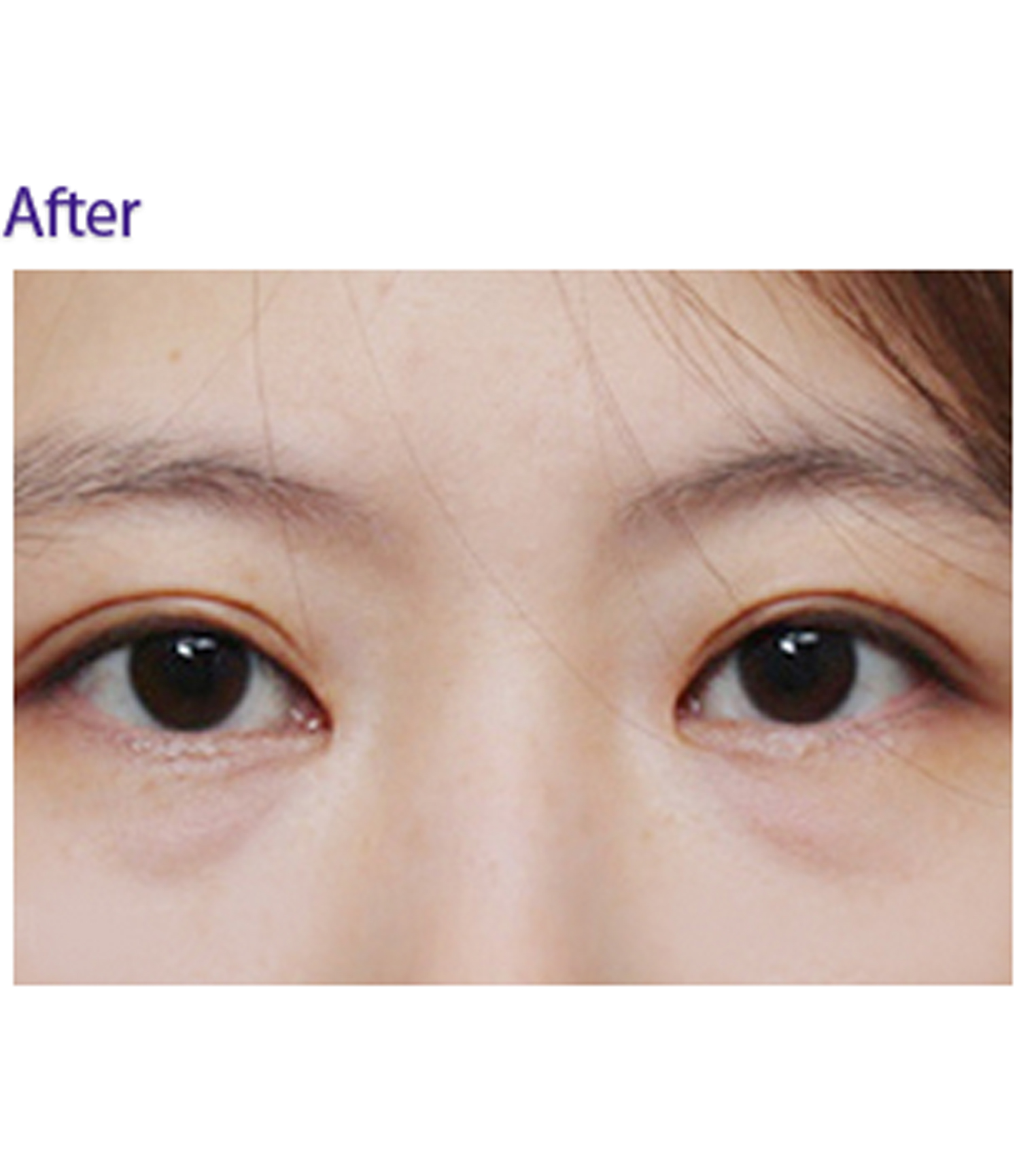 韩国mvp整形外科双眼皮手术对比图