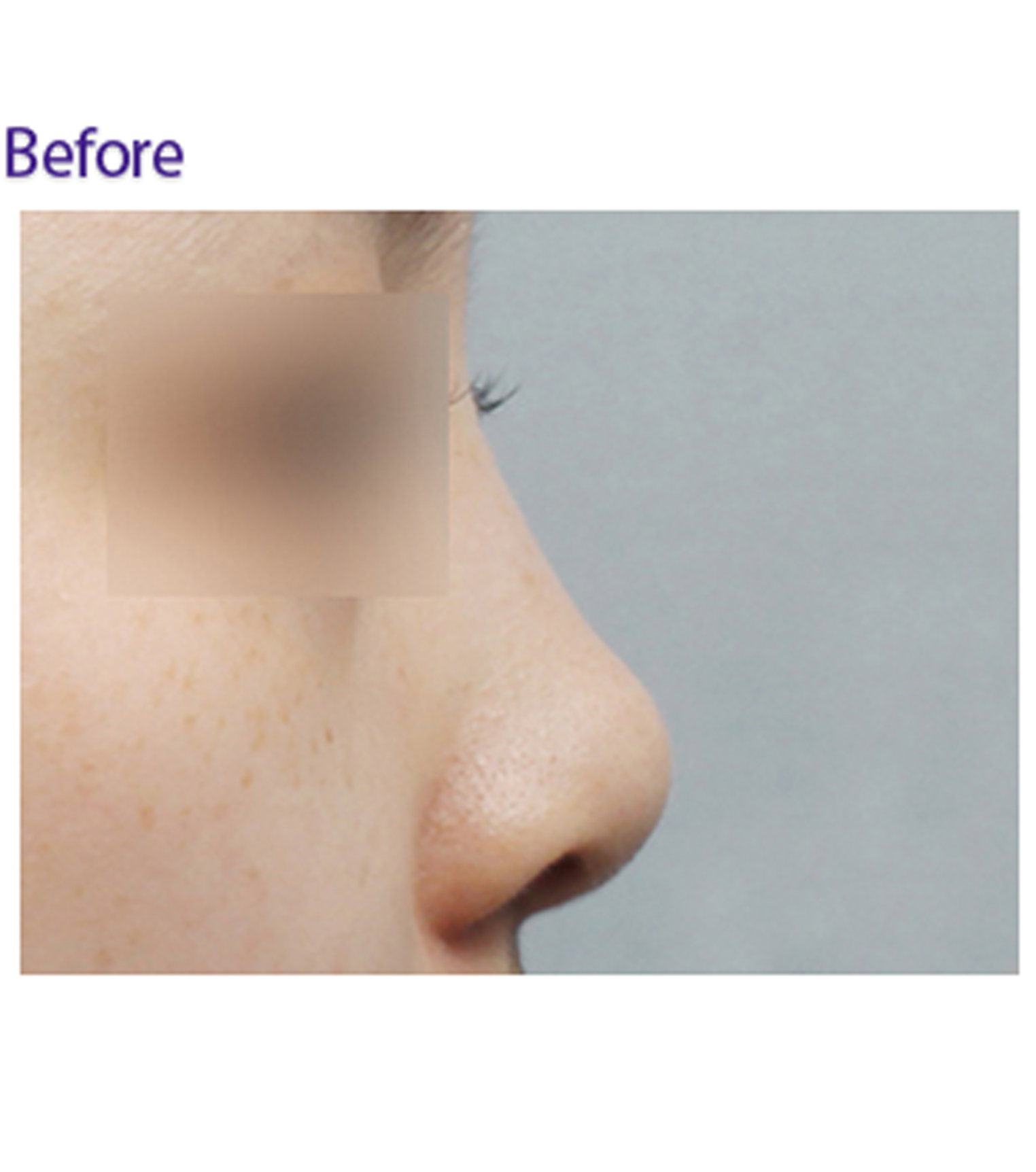 隆鼻手术对比图