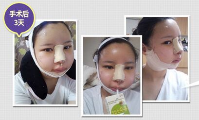 韩式隆鼻手术整形经历