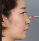 韩国自然主义整形外科箭头鼻矫正对比案例_术前