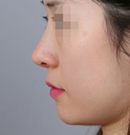 韩国自然主义整形外科驼峰鼻矫正对比案例