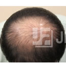 毛发移植手术前后对比案例_术前