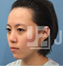韩国JP整形-纹发际线手术前后对比日记