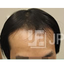 韩国JP整形-头发种植手术前后对比日记