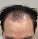 纹发际线手术前后对比案例_术前