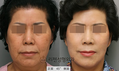 面部抗衰老整形对比案例