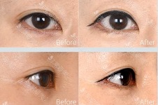 韩国爱丽克INIQUE整形医院在韩国人专场眼修复皮肤优惠！