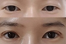 韩国EH爱护整形医院9月优惠活动来袭，男士双眼皮提肌手术15%的折扣只需8.5折！