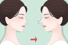 韩国GNG医院初次隆鼻600万韩币，贴心赠送一晚住宿，轻松变型男！