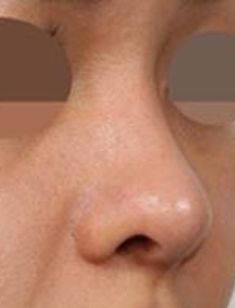 -韩国dvora薄皮肤隆鼻修复案例照片图