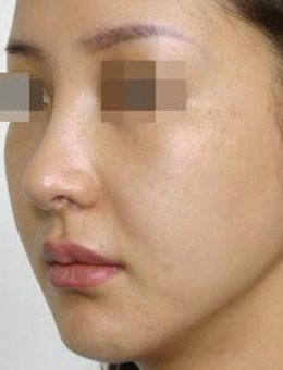 韩国dvora鼻综合鼻子太尖修复案例图